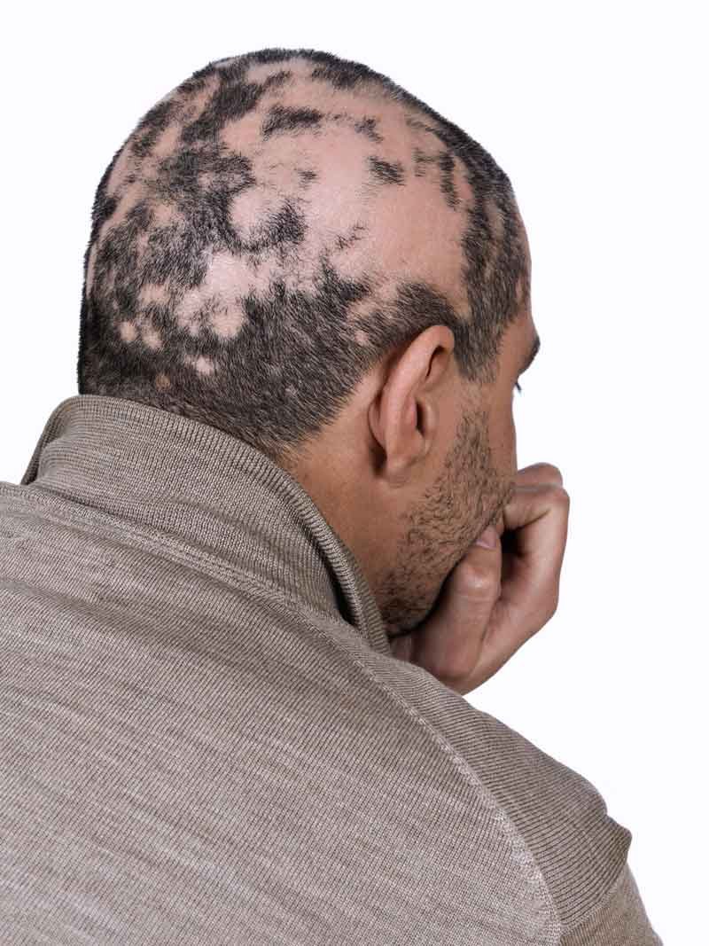 Alopecia Universal S Ntomas Causas Y Tratamiento