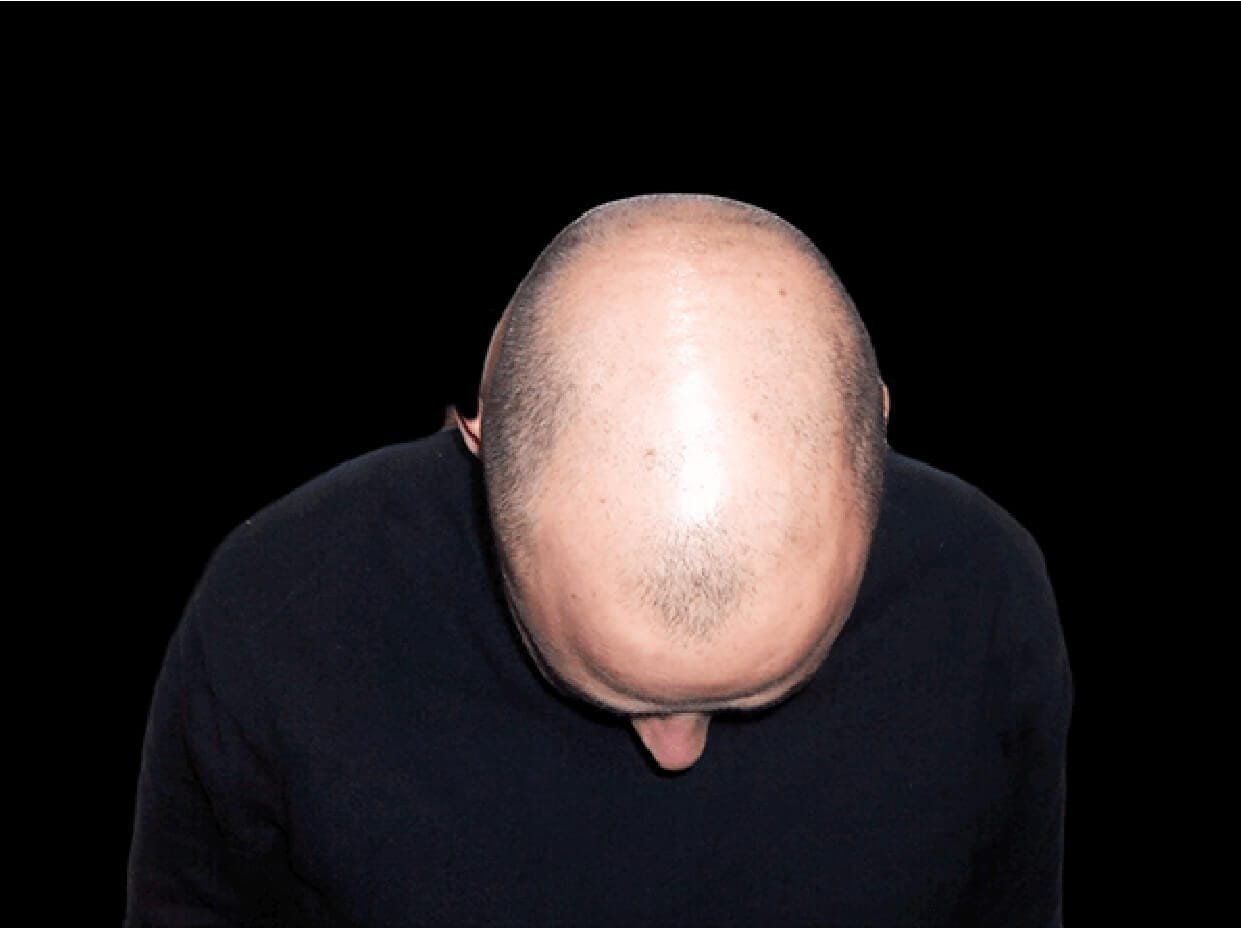 Efluvio telogénico Man Medical Institute Consejos capilares