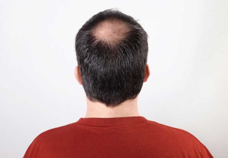 itálico Hombre Delincuente Alopecia androgénica masculina: causas y tratamiento