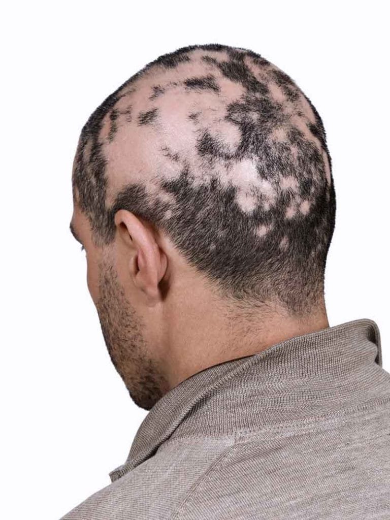 alopecia-universal-s-ntomas-causas-y-tratamiento