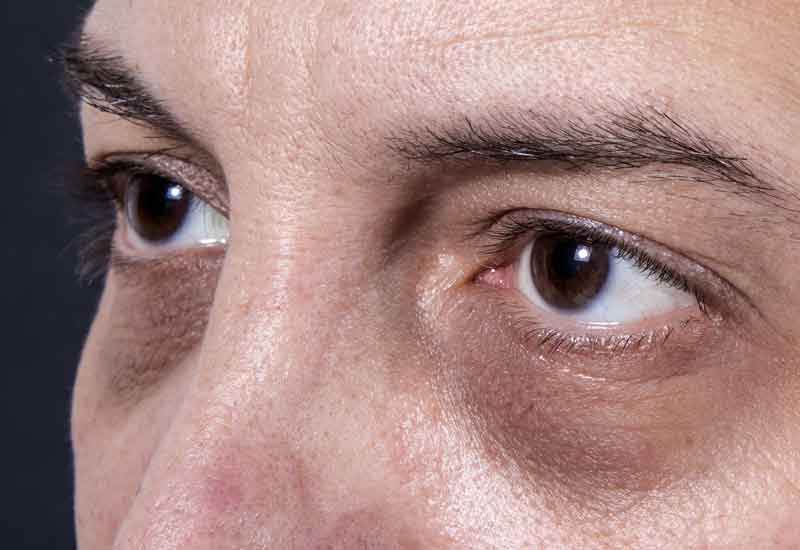 Pato Convencional reparar Bolsas en los ojos: ¿Qué son? ¿Cómo podemos eliminarlas?