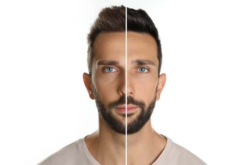 Resultados del trasplante capilar | Man Medical Institute